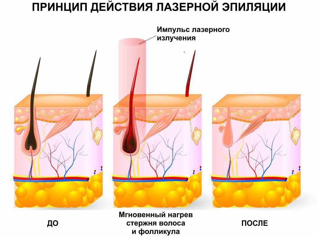 Лазерная Эпиляция Бикини Классическое Фото