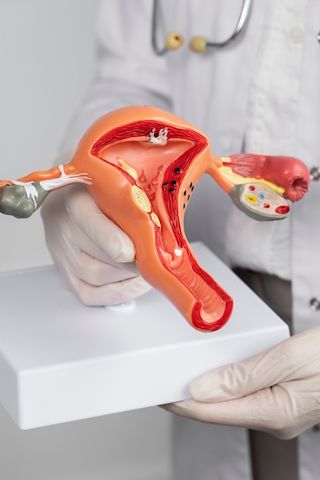 Киста яичника