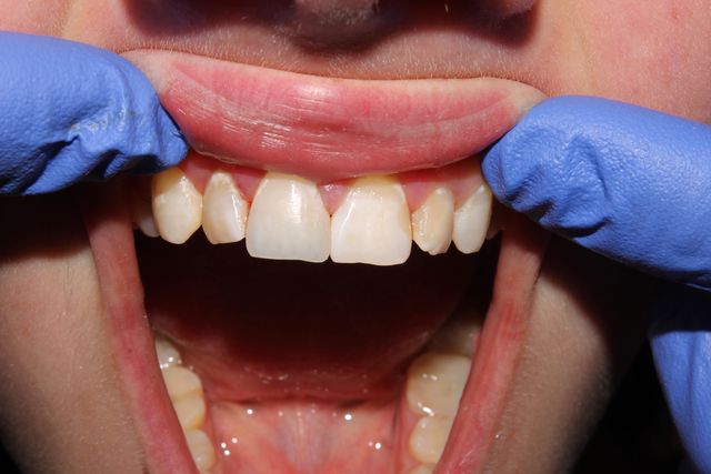 Пластика уздечки языка 6