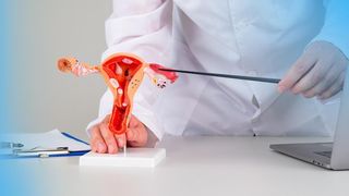 Киста яичника