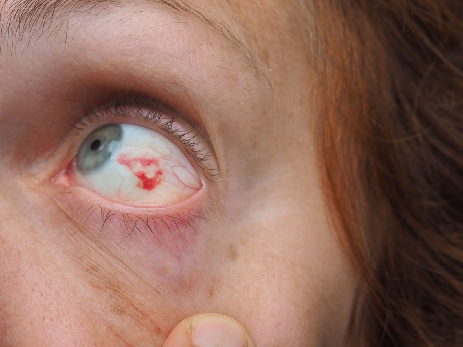 Кровоизлияние в глаз