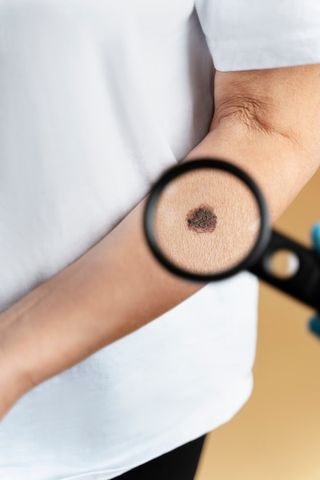 Биопсию родинки