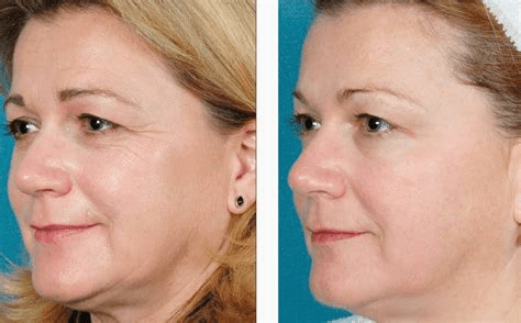 Спейслифтинг