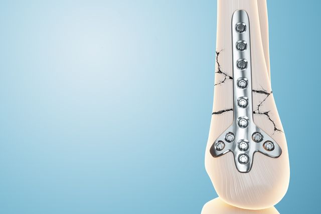 Остеосинтез