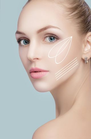 Пластика скул