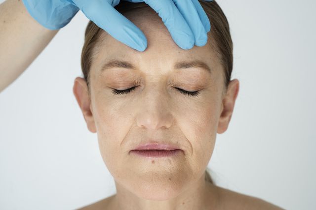 Подтяжка нитями «Аптос» 3