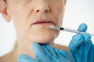 Подтяжка подбородка