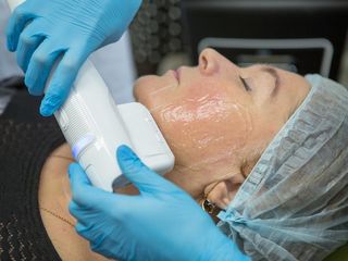 СМАС-лифтинг на Ультраформер 3