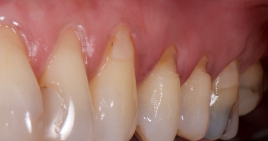 klinovidnii defect zuba.jpg