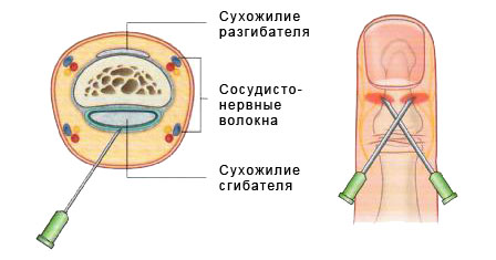 Вросший ноготь.jpg Вросший ноготь.jpg