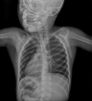 Рентген грудной клетки детям