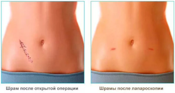 Лапароскопия желчного пузыря 