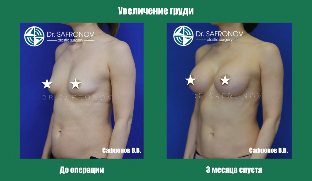 Увеличение груди Увеличение груди