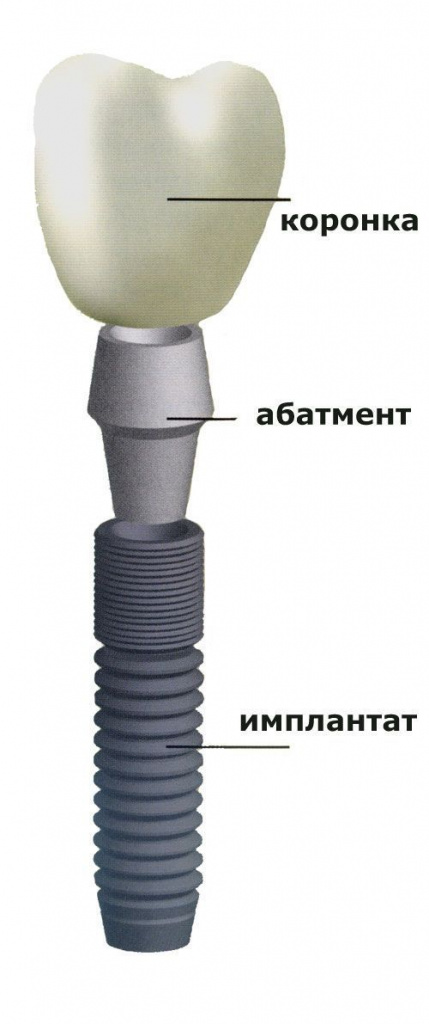 Имплантация зубов Имплантация зубов