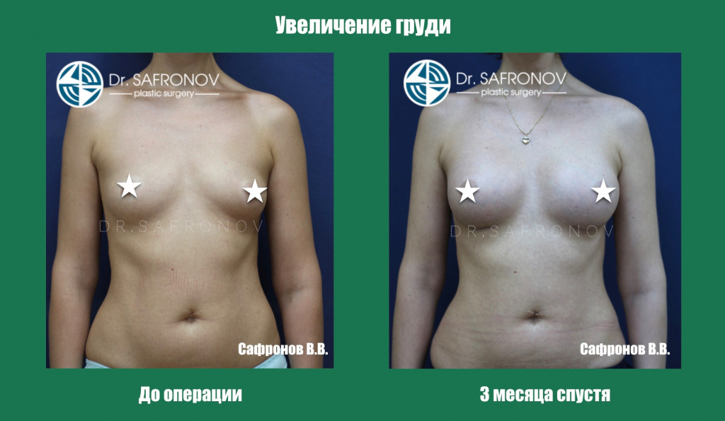 Увеличение груди Увеличение груди