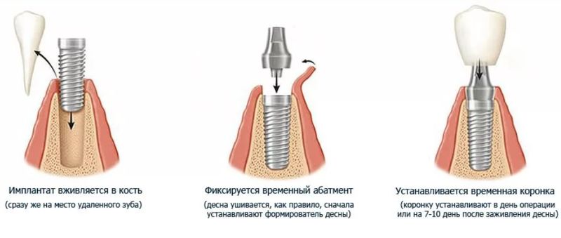 Имплантация зубов Имплантация зубов