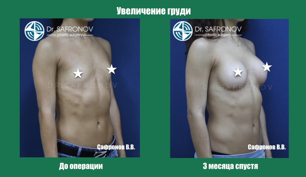 Увеличение груди Увеличение груди