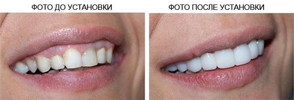 виниры3.jpg виниры3.jpg