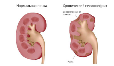Пиелонефрит Пиелонефрит.jpg
