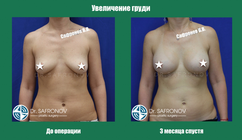 Увеличение груди Увеличение груди