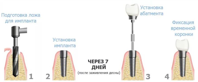 Имплантация зубов Имплантация зубов