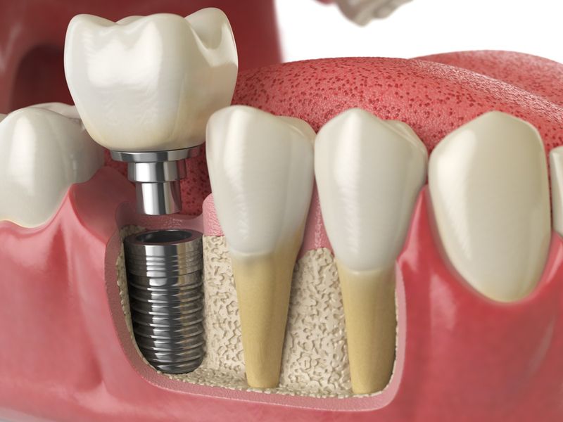Современная имплантация зубов и ее плюсы