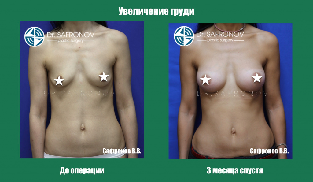 Увеличение груди Увеличение груди